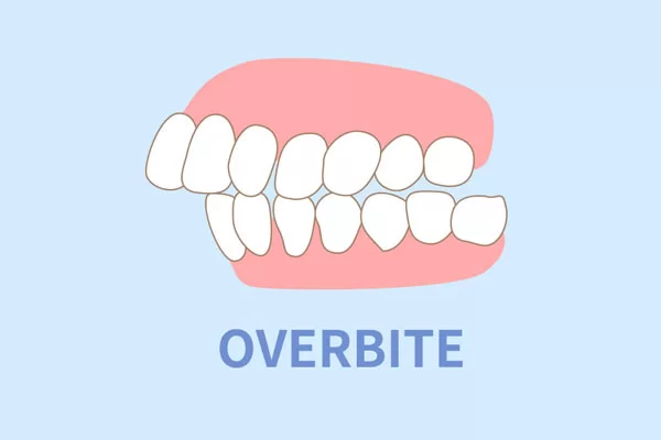 overbites