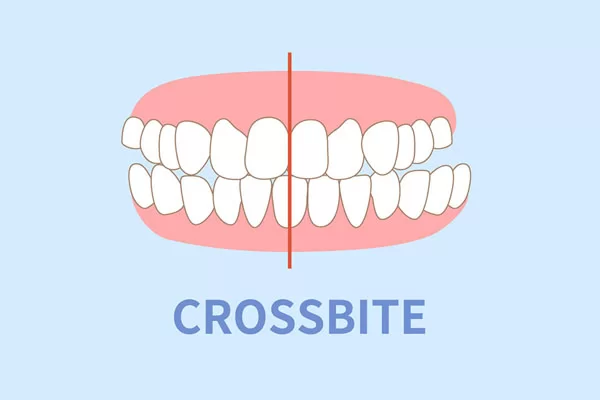 crossbites