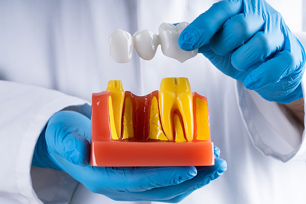 dental bridges near you