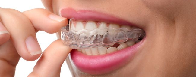 putting on Invisalign clear aligner tray