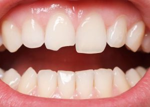 patient has chipped tooth that will be treated with dental bonding