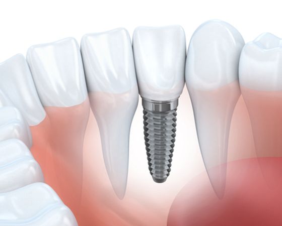 dental implant after healing period