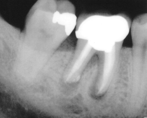 root canal treatment for affected tooth shown on x-ray