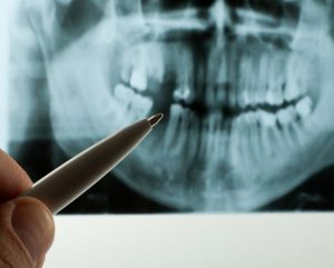 Dental X-ray image with a hand holding a pen, highlighting areas relevant to full mouth reconstruction services at Brown and Baran Family Dentistry.