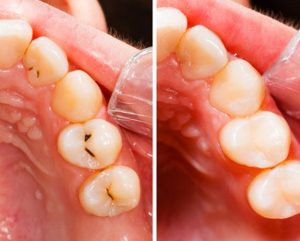 before and after tooth colored fiilings treatment